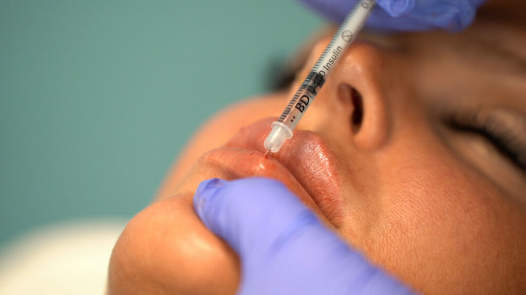 Close-up image of a med spa professional wearing gloves carefully injecting a small amount of filler into a client's lips. Lip fillers enhance lip volume and definition for a fuller, plumper appearance.