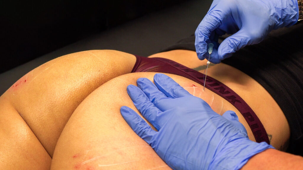 Close-up image of a med spa professional wearing gloves inserting a thin PDO thread with a needle into a client's cheek area. PDO threads are dissolvable sutures that stimulate collagen production and provide a subtle lifting effect to the skin.