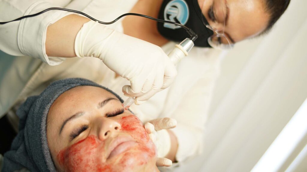 Close-up image of a med spa aesthetician using a microneedling roller with tiny needles to create controlled punctures in a person's skin to stimulate collagen production and improve skin texture.